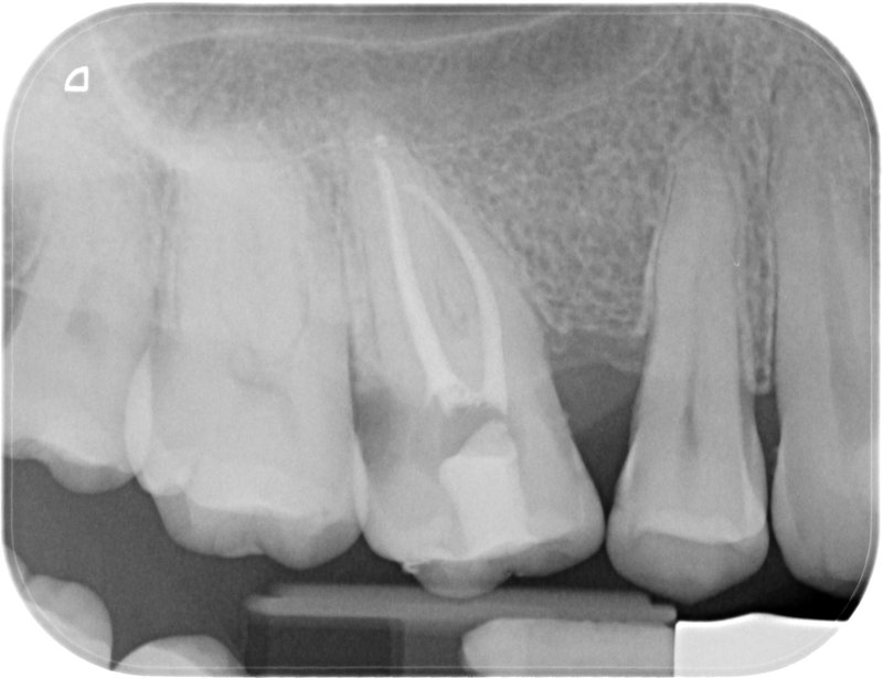 Endodoncia caso 3 Resultado Final