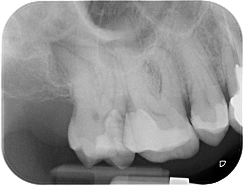 Endodoncia caso 1 Estado Inicial