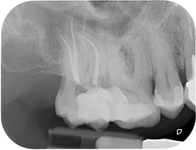 Endodoncia caso 1 Resultado Final