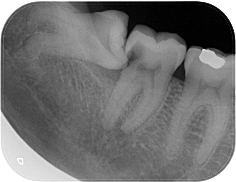 Endodoncia caso 2 Estado Inicial