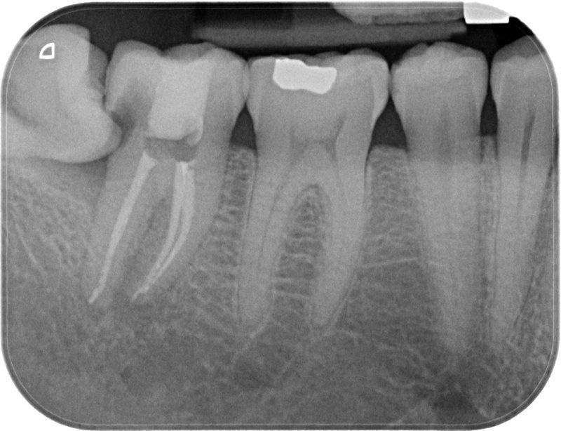 Endodoncia caso 2 Resultado Final