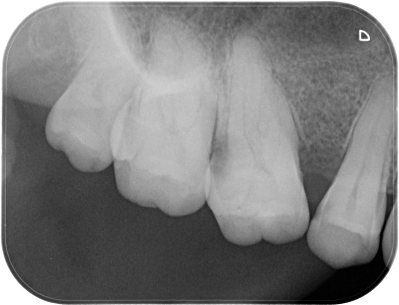 Endodoncia caso 3 Estado Inicial