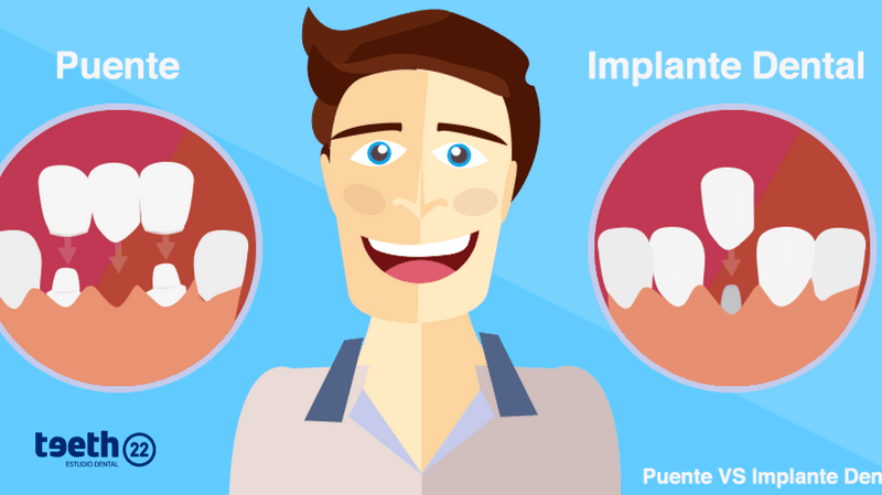 Implante Dental vs Puente. ¿Cuál elegir?.