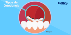 Ortodoncia lingual