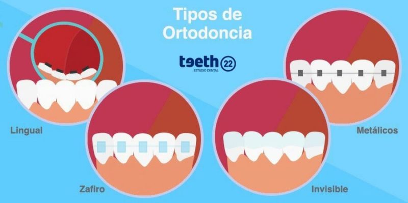 Tipos de ortodoncia