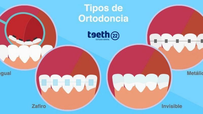 Tipos de ortodoncia