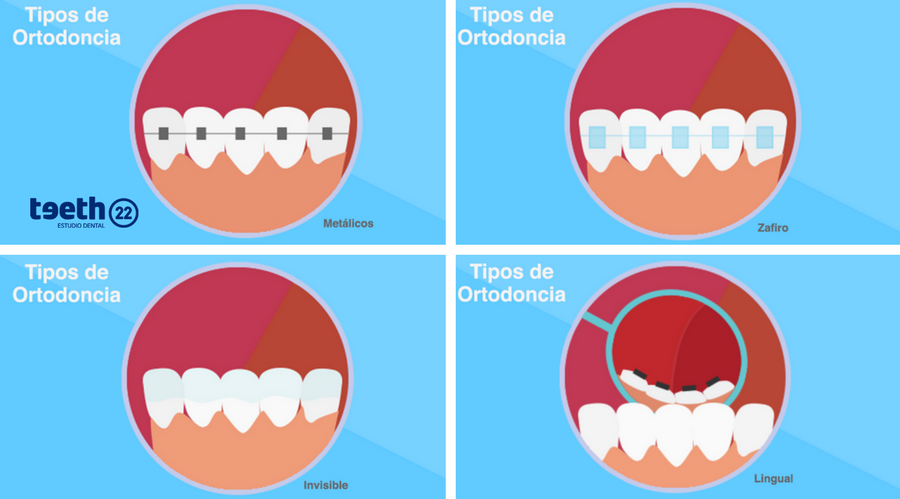 Tipos de Ortodoncia, ventajas e incovenientes