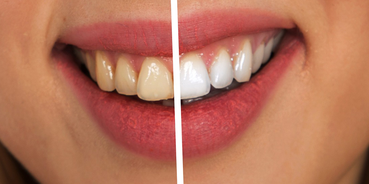 ¿Cómo cuidar tus dientes después de un blanqueamiento dental? Teeth 22