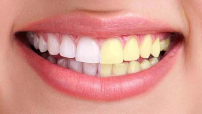 Resultados blanqueamiento dental