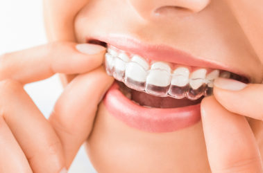 Invisalign - Ortodoncia invisible