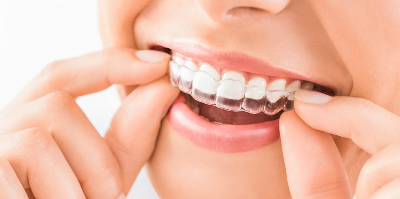 Invisalign - Ortodoncia invisible