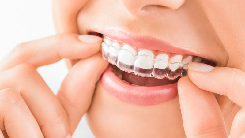 Invisalign - Ortodoncia invisible