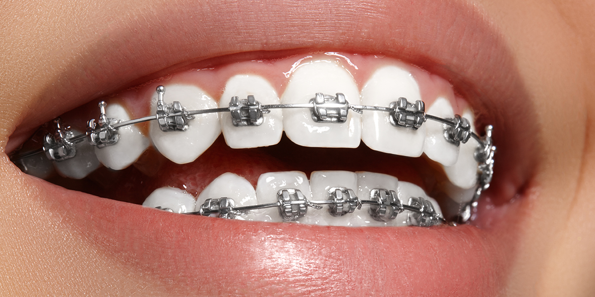 Amperio A fondo Producto Cómo cuidar los dientes durante un tratamiento de ortodoncia | Teeth 22