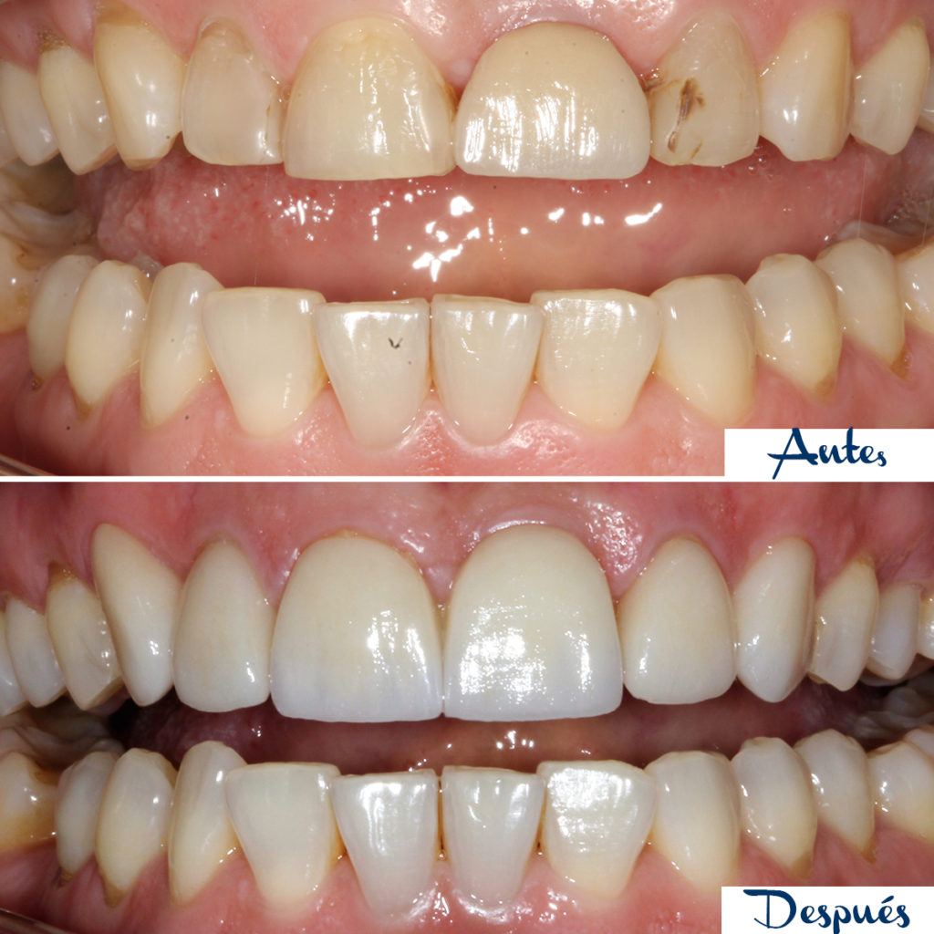 Antes y después de un tratamiento de estética dental