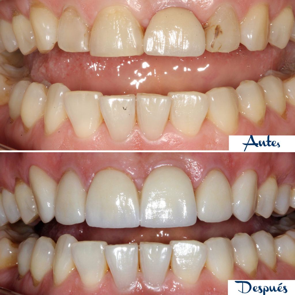 Antes y después tratamientos dentales en Manresa