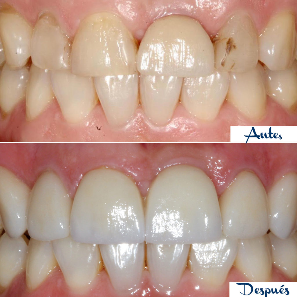 Antes y después de un tratamiento de estética dental