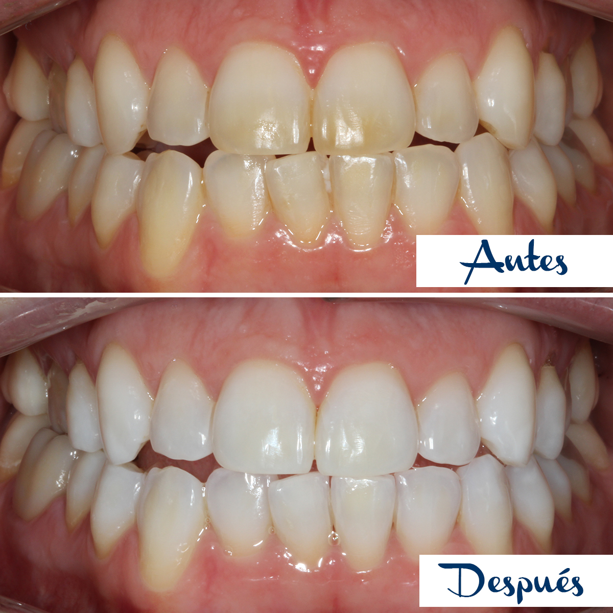 Antes y después de un blanqueamiento dental