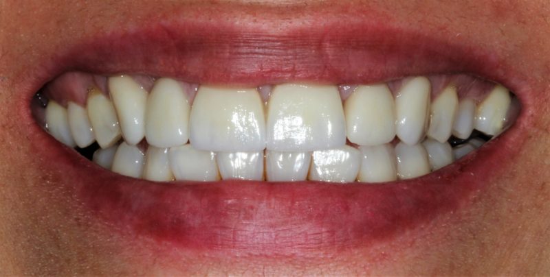 Hoy os traemos el antes y el después de un tratamiento de estética dental que combina carillas, coronas sobre implantes y un blanqueamiento dental.