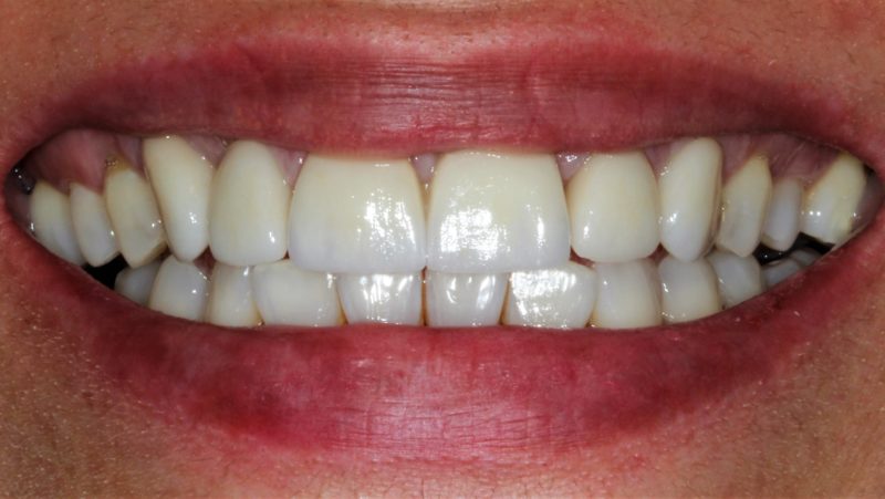 Hoy os traemos el antes y el después de un tratamiento de estética dental que combina carillas, coronas sobre implantes y un blanqueamiento dental.