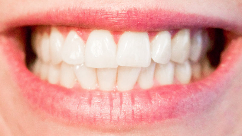 Caries dental: qué es y cómo prevenirla