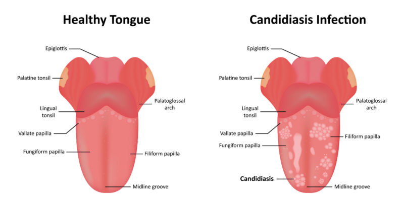 Candidiasis bucal