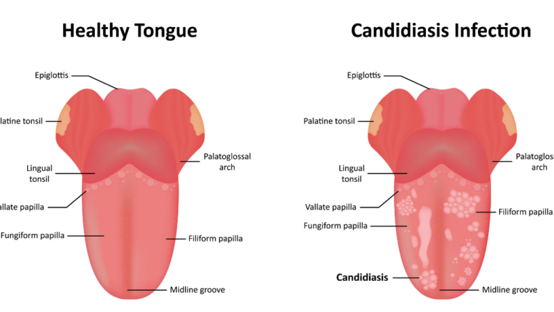 Candidiasis bucal