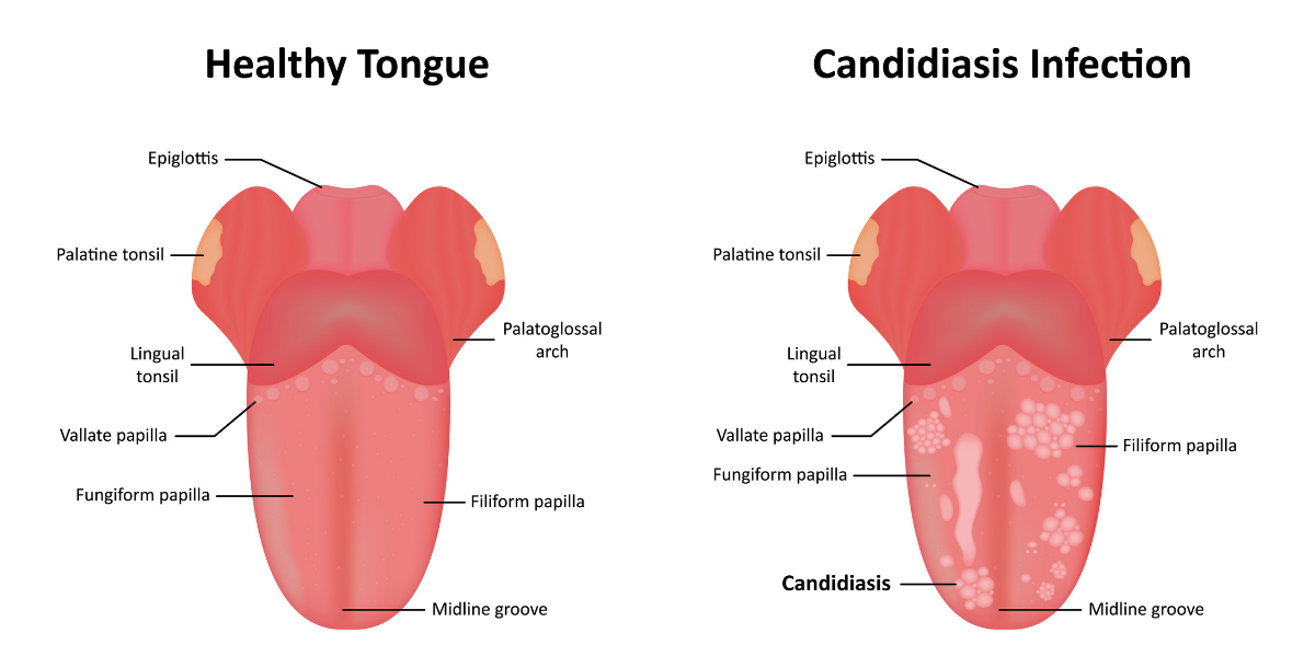 Candidiasis Bucal Causas Sintomas Y Tratamiento Teeth 22 Candidiasis Bucal Causas Sintomas Y Tratamiento Teeth 22