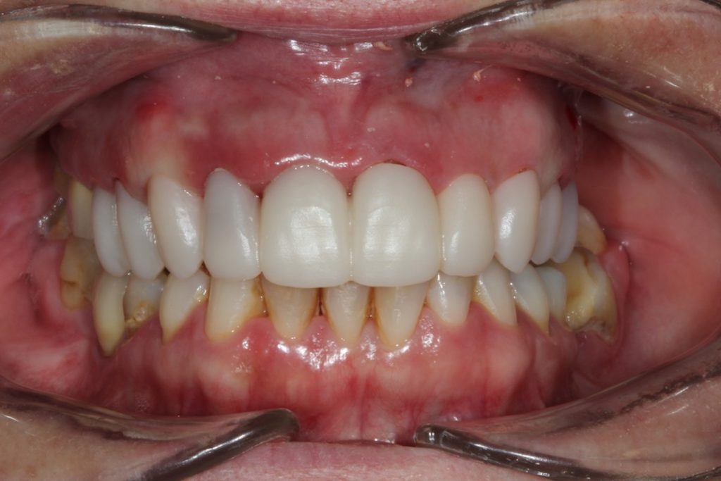 Tratamiento coronas de zirconio