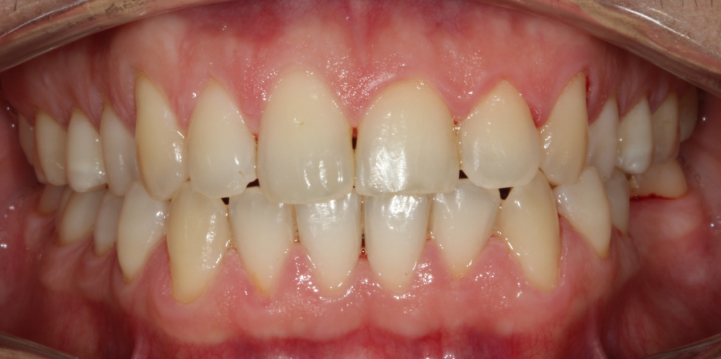 Profilaxis con antes y Teeth 22