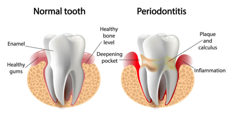 periodontitis