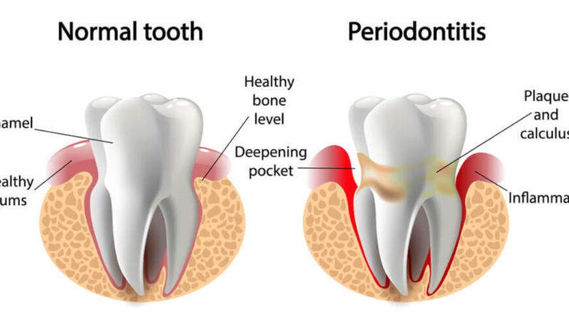 periodontitis