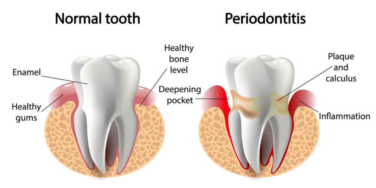 ¿Qué es la periodontitis? | Teeth 22