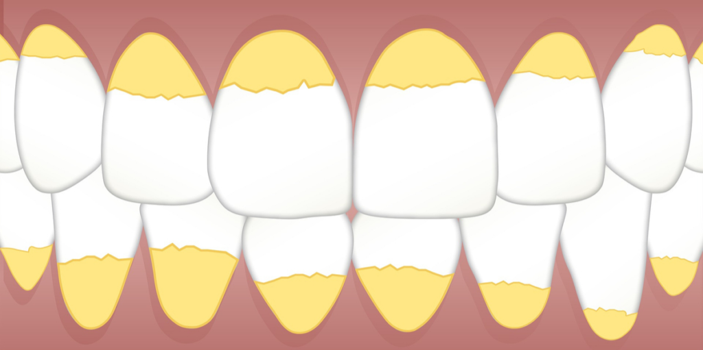 Todo lo que necesitas saber sobre la placa dental | Teeth 22