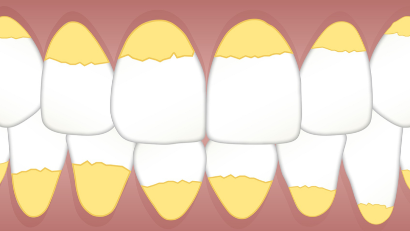 Lágrimas Pintura Interpretar Todo lo que necesitas saber sobre la placa dental | Teeth 22